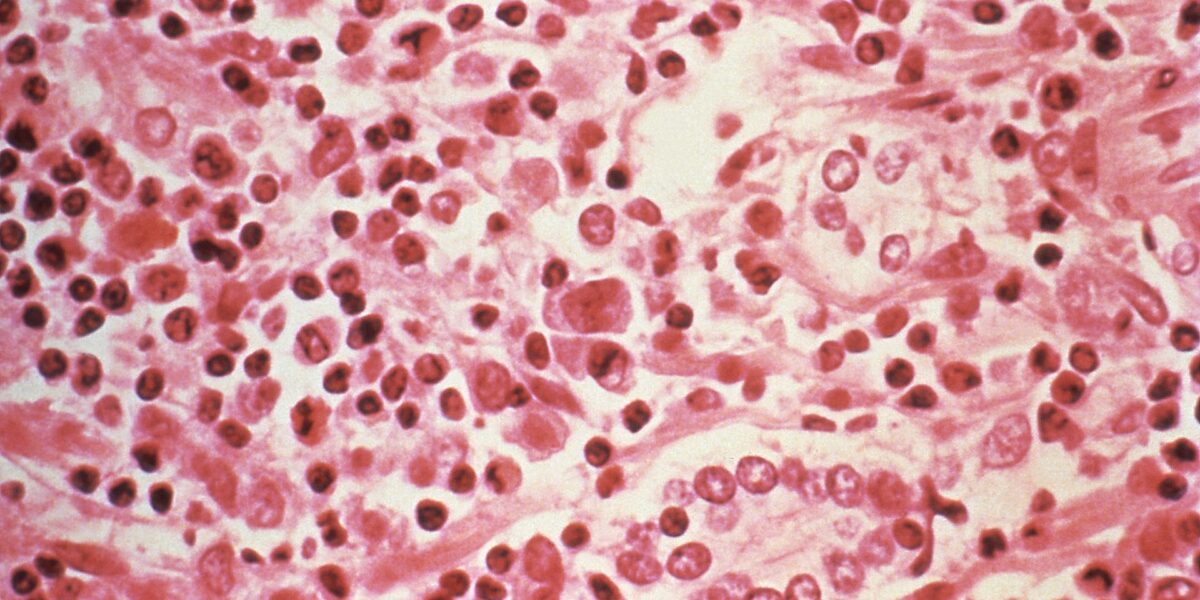 CDC microscopic image of a liver tissue specimen from a hantavirus pulmonary syndrome (HPS) patient