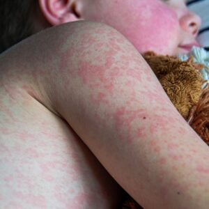 Close-up of a boy with a widespread red, blotchy rash covering their face, shoulder, arm, and torso