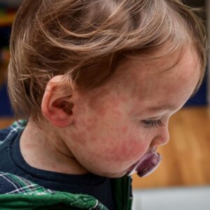 Close-up of a young child with a red, blotchy rash across the face and neck, with a pacifier in their mouth