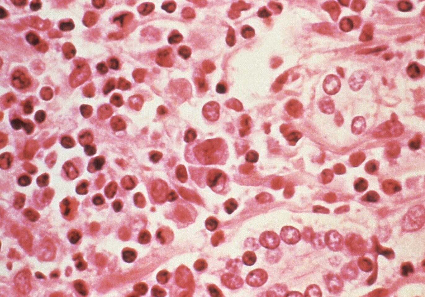CDC microscopic image of a liver tissue specimen from a hantavirus pulmonary syndrome (HPS) patient